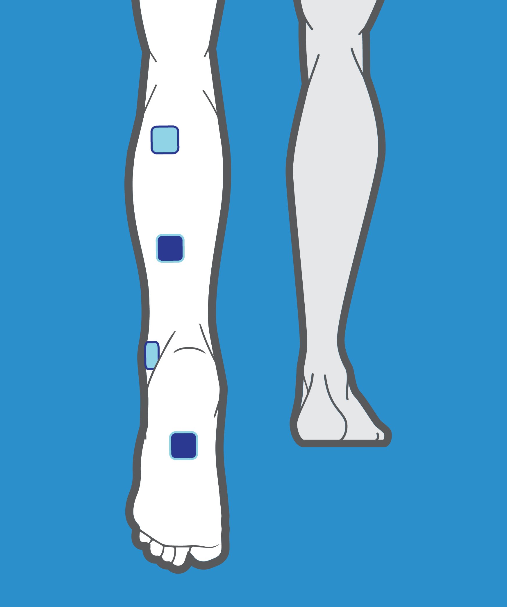 TENS Unit Placement for Foot Pain - iTENS Australia