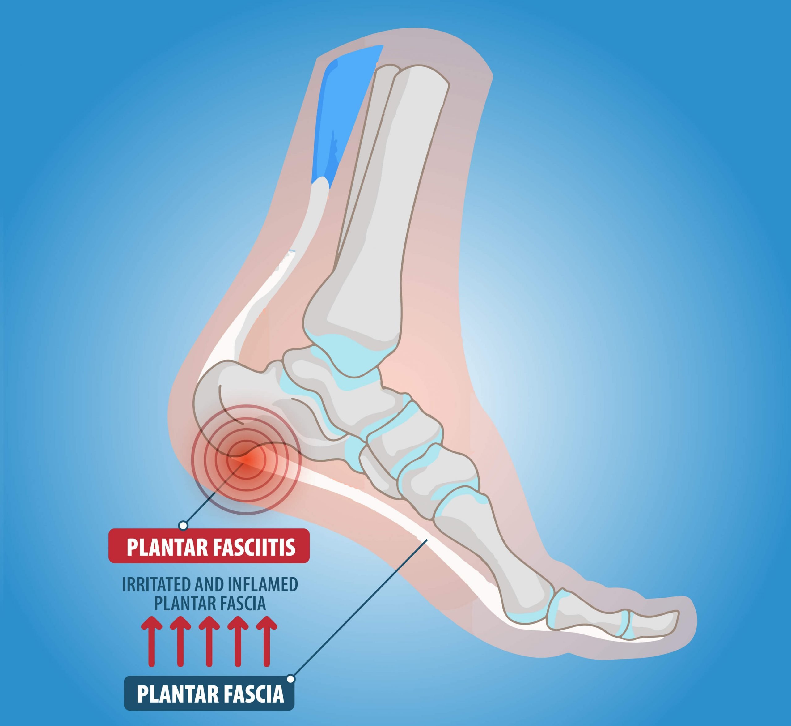 Heel Pain Treatment for Women at St. Theresa's Hospital