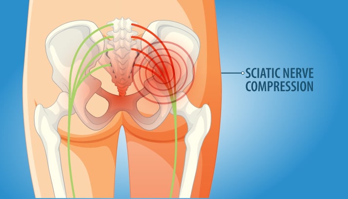 How TENS Can Help With Sciatica 